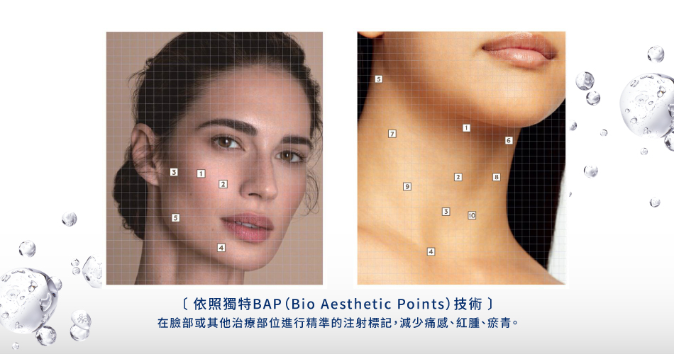 依照獨特BAP（Bio Aesthetic Points）技術，在臉部或其他治療部位進行精準的注射標記，可以減少痛感、紅腫、瘀青及療程次數